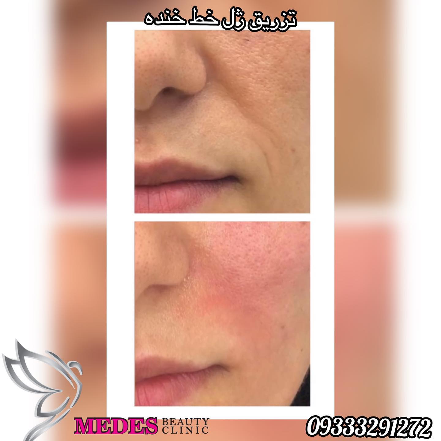 تزریق ژل خط خنده